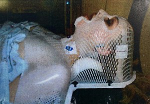 radiation treatment simulation