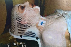 radiation treatment simulation